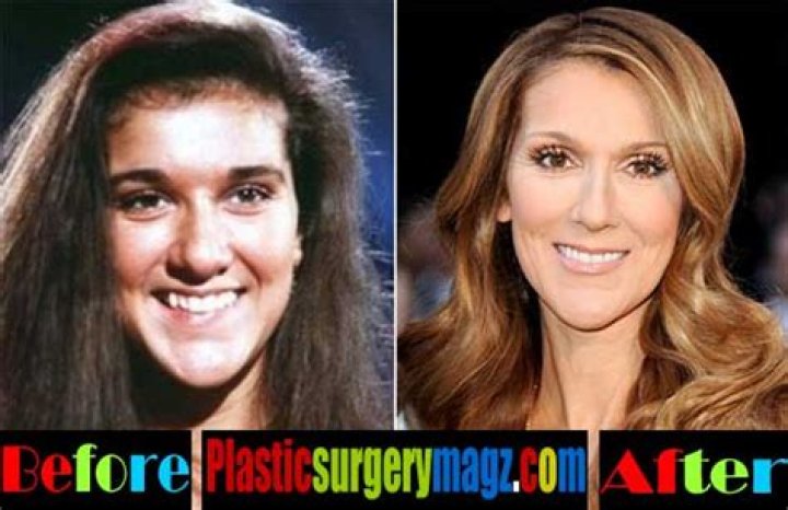 Celine Dion Nose Job Plastic Surgery Before and After ·
